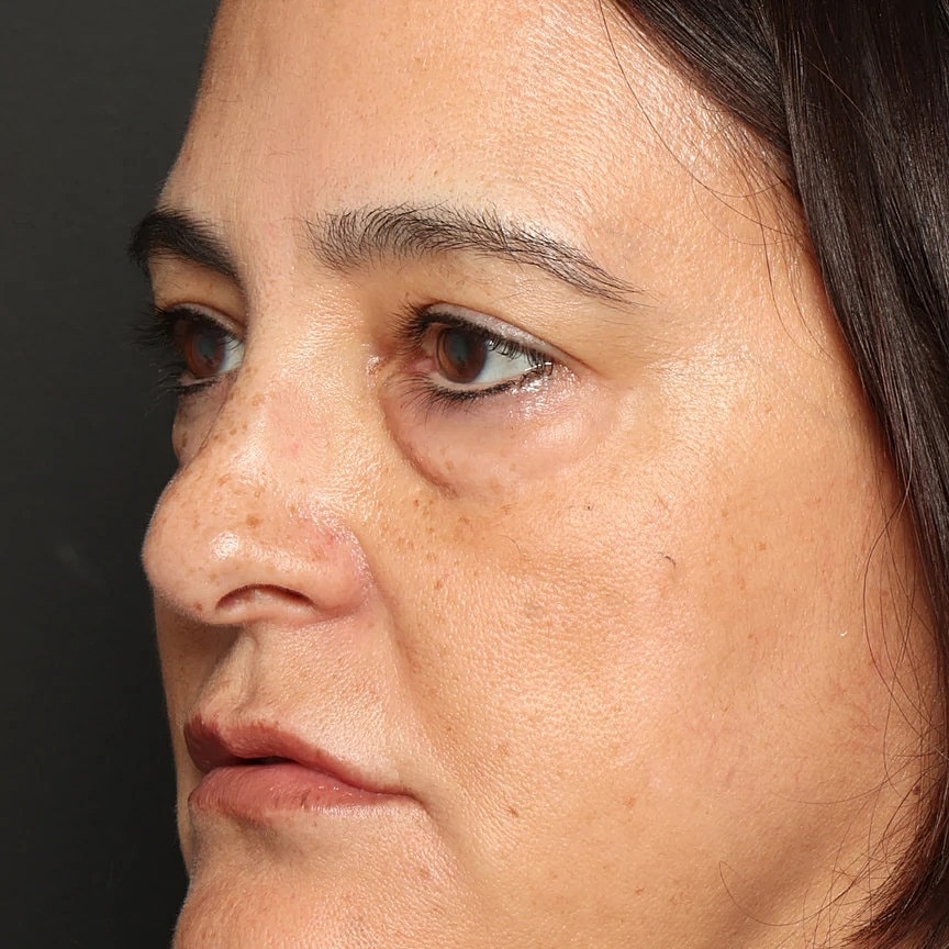 Blepharoplasty Before & After