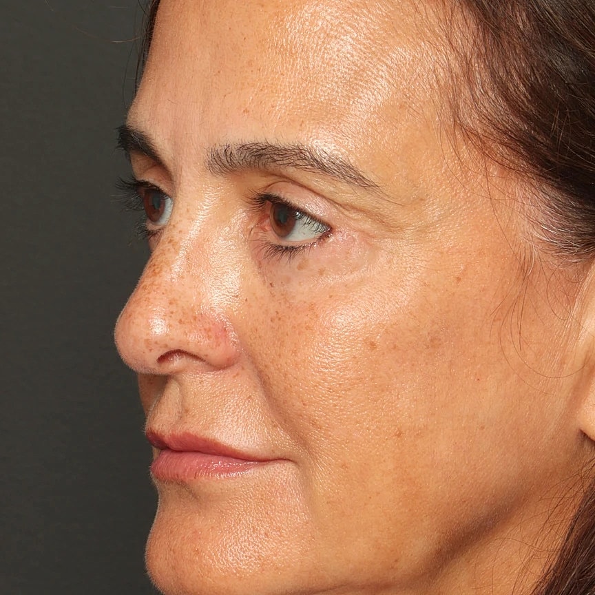 Blepharoplasty Before & After