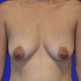 Breast Augmentation With Lift Before & After