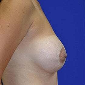 Breast Augmentation With Lift Before & After