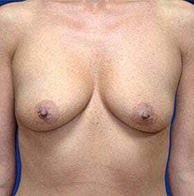 Breast Augmentation With Lift Before & After
