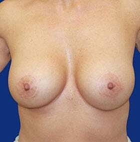 Breast Augmentation With Lift Before & After