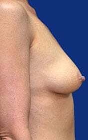 Breast Augmentation With Lift Before & After