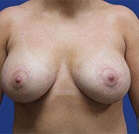 Breast Augmentation With Lift Before & After