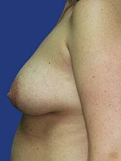 Breast Augmentation With Lift Before & After
