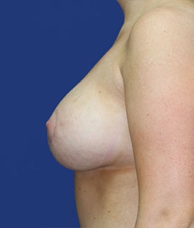 Breast Augmentation With Lift Before & After
