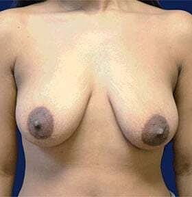 Breast Augmentation With Lift Before & After