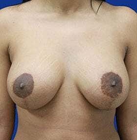 Breast Augmentation With Lift Before & After