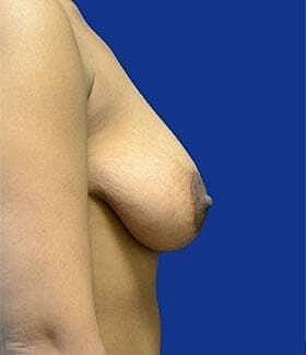 Breast Augmentation With Lift Before & After