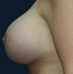 Breast Augmentation With Lift Before & After