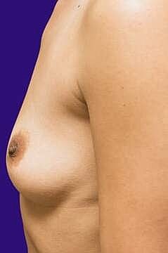 Breast Augmentation With Lift Before & After