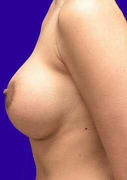 Breast Augmentation With Lift Before & After