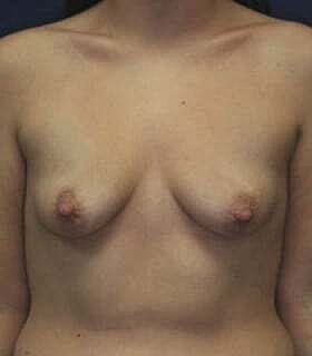 Breast Augmentation With Lift Before & After
