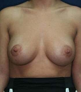 Breast Augmentation With Lift Before & After