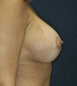 Breast Augmentation With Lift Before & After