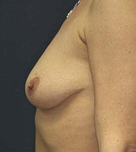 Breast Augmentation With Lift Before & After