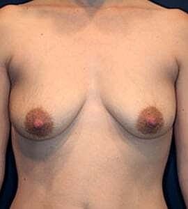 Breast Augmentation With Lift Before & After