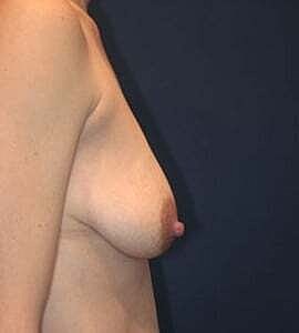 Breast Augmentation With Lift Before & After