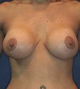 Breast Augmentation With Lift Before & After