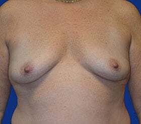 Breast Augmentation With Lift Before & After
