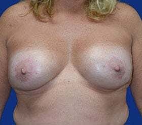 Breast Augmentation With Lift Before & After