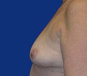 Breast Augmentation With Lift Before & After