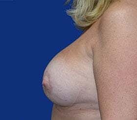 Breast Augmentation With Lift Before & After
