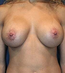 Breast Augmentation With Lift Before & After
