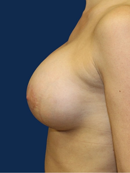 Breast Augmentation With Lift Before & After