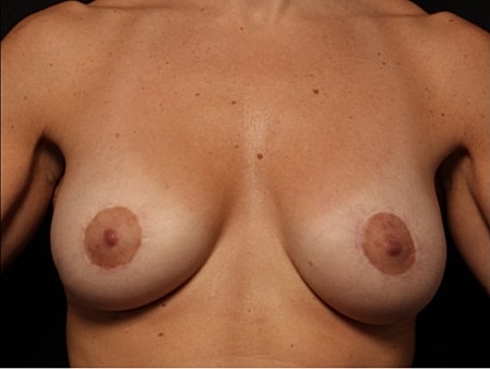 Breast Augmentation With Lift Before & After