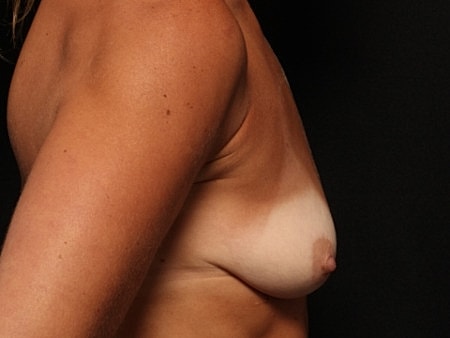 Breast Augmentation With Lift Before & After
