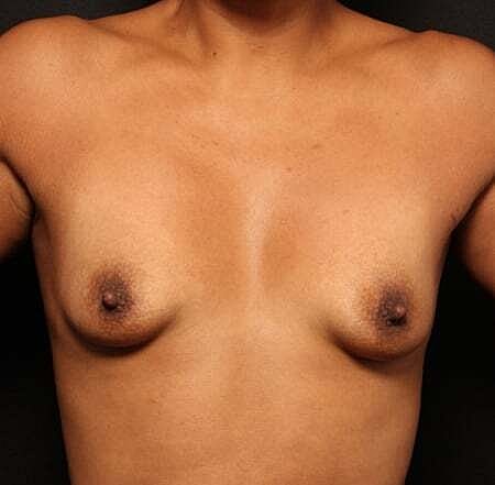 Breast Augmentation With Lift Before & After