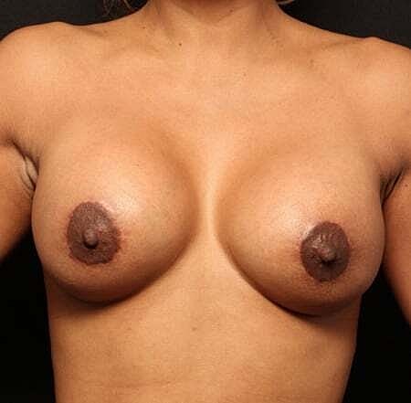 Breast Augmentation With Lift Before & After