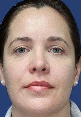 Facial Fillers Before & After