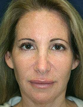 Facial Fillers Before & After