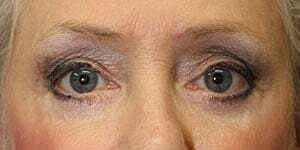 Facial Fillers Before & After