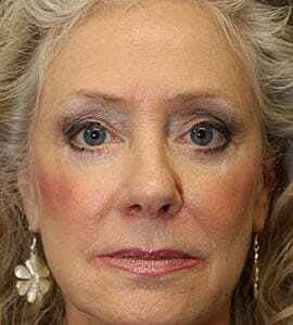 Facial Fillers Before & After