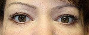 Facial Fillers Before & After