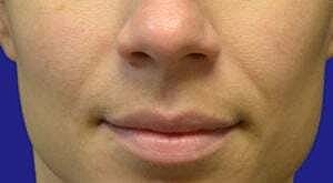 Facial Fillers Before & After