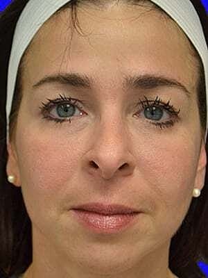 Facial Fillers Before & After