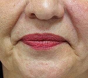Facial Fillers Before & After