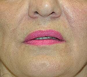 Facial Fillers Before & After