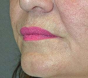 Facial Fillers Before & After