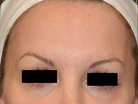 Facial Fillers Before & After