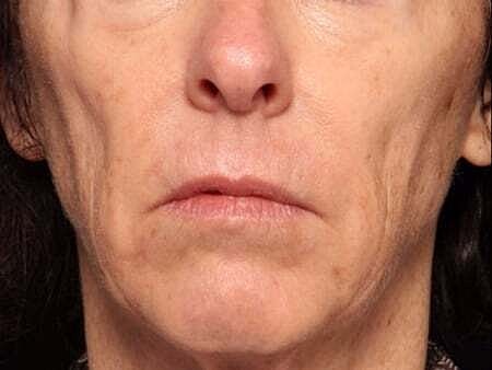 Facial Fillers Before & After