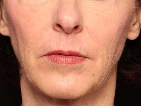 Facial Fillers Before & After