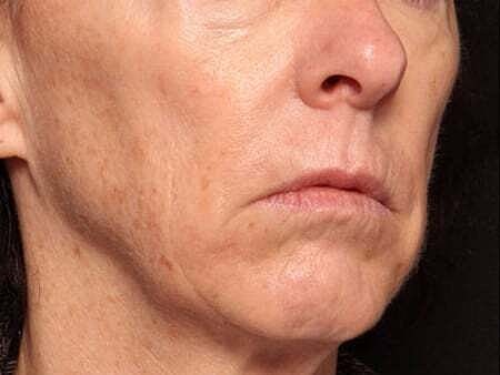 Facial Fillers Before & After