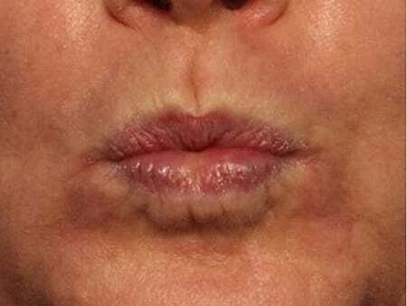 Facial Fillers Before & After