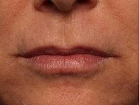 Facial Fillers Before & After