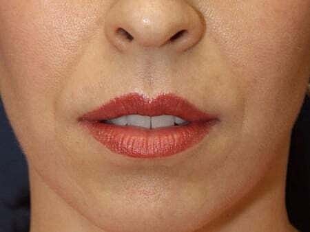 Facial Fillers Before & After